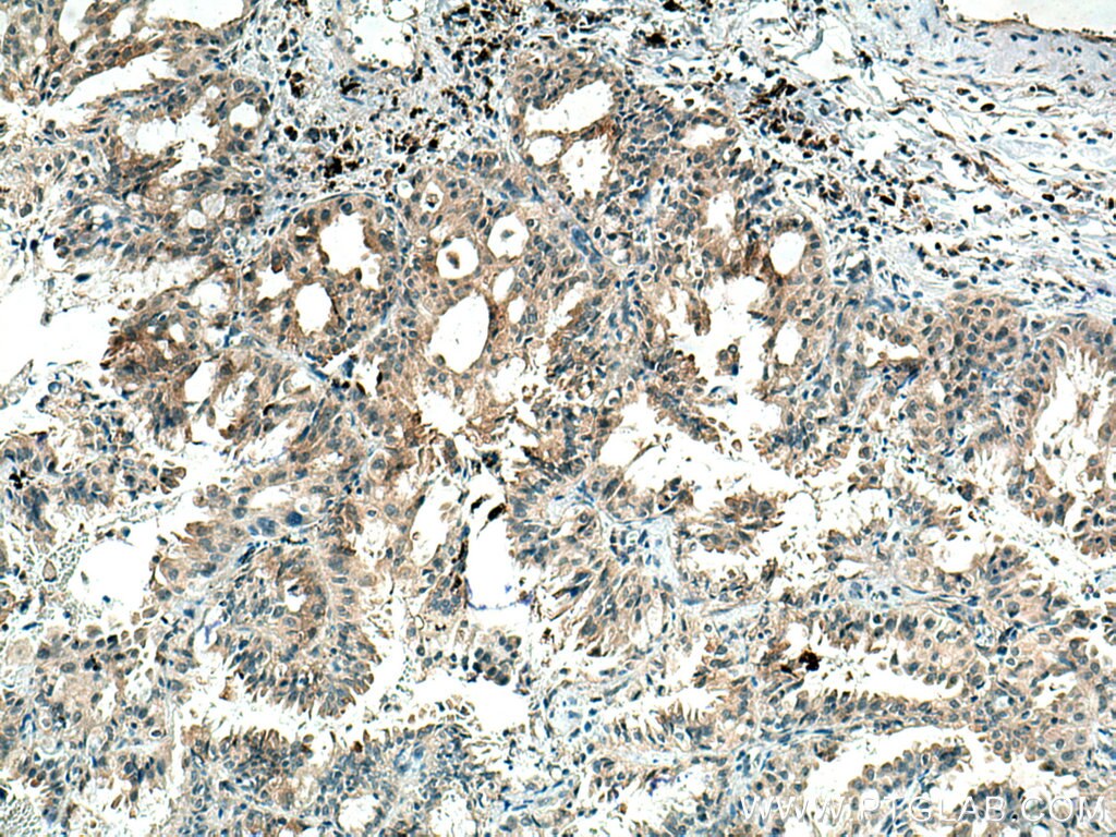 Immunohistochemistry (IHC) staining of human lung cancer tissue using RABEPK/p40 Monoclonal antibody (66622-1-Ig)