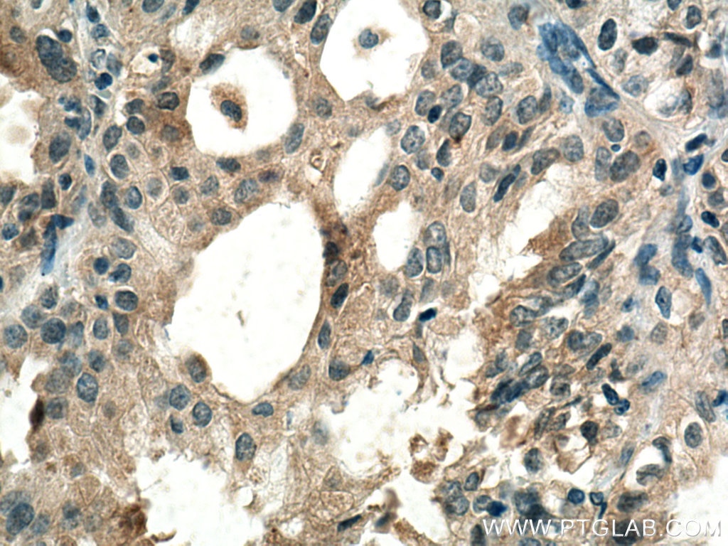 Immunohistochemistry (IHC) staining of human lung cancer tissue using RABEPK/p40 Monoclonal antibody (66622-1-Ig)