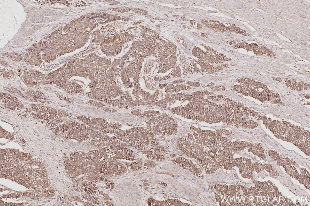 Immunohistochemistry (IHC) staining of human stomach cancer tissue using RABGAP1 Polyclonal antibody (14223-1-AP)