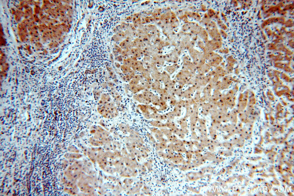 Immunohistochemistry (IHC) staining of human hepatocirrhosis tissue using RABGAP1L Polyclonal antibody (13894-1-AP)