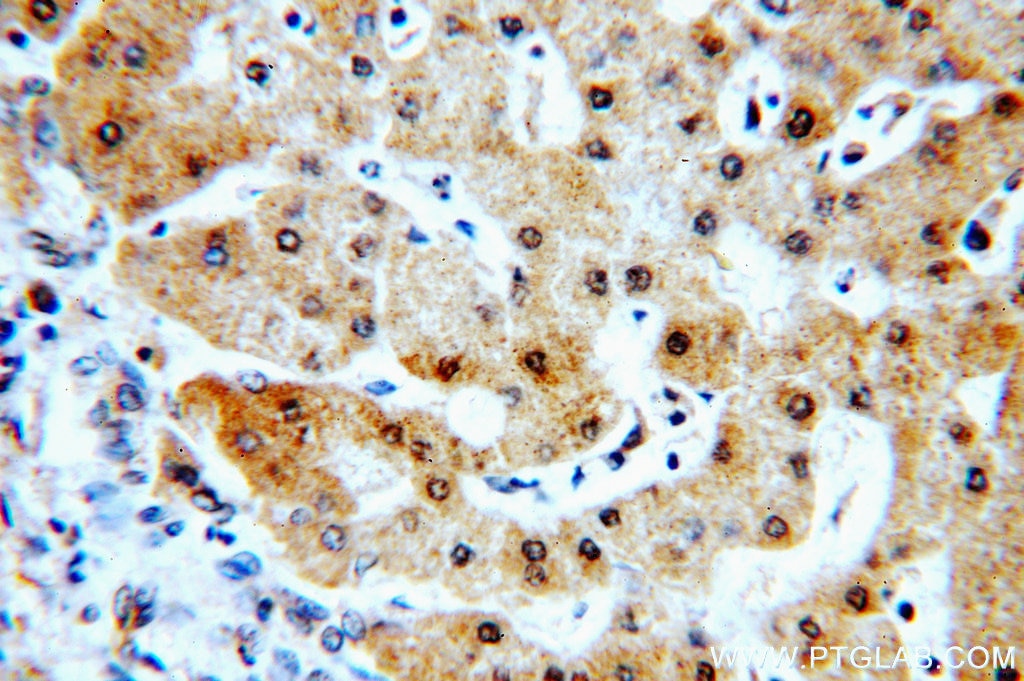Immunohistochemistry (IHC) staining of human hepatocirrhosis tissue using RABGAP1L Polyclonal antibody (13894-1-AP)