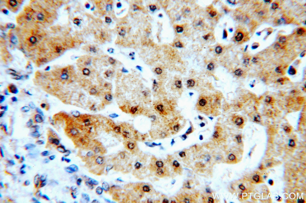 Immunohistochemistry (IHC) staining of human hepatocirrhosis tissue using RABGAP1L Polyclonal antibody (13894-1-AP)