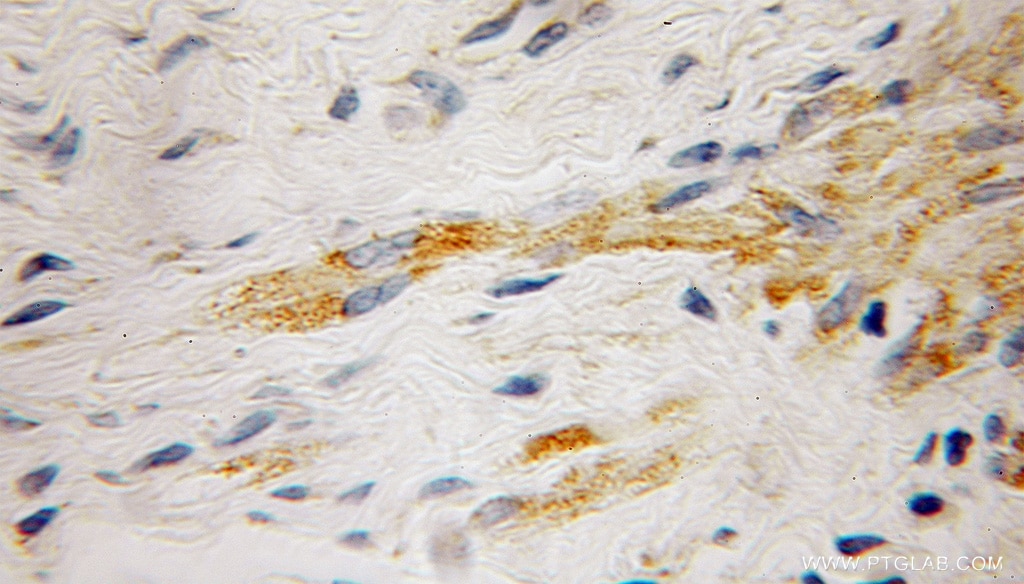 Immunohistochemistry (IHC) staining of human endometrial cancer tissue using RabGEF1 Polyclonal antibody (12735-1-AP)