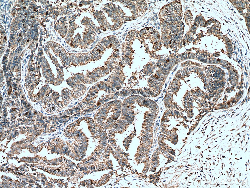 Immunohistochemistry (IHC) staining of human ovary tumor tissue using RABL2A Polyclonal antibody (17816-1-AP)