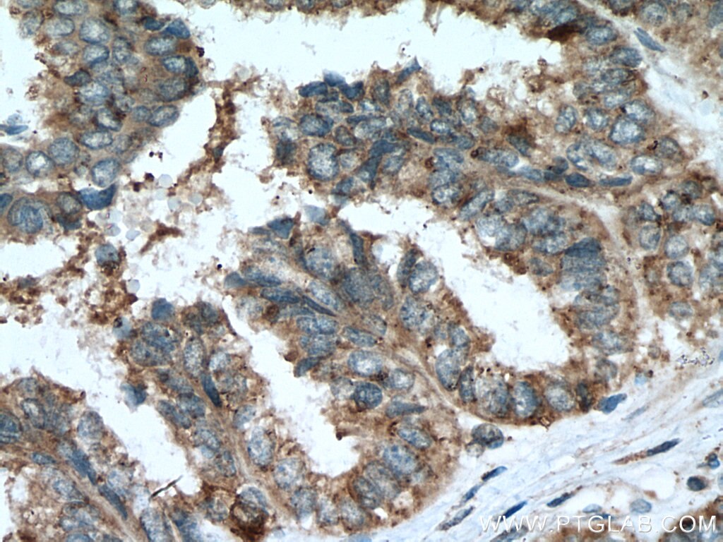 Immunohistochemistry (IHC) staining of human ovary tumor tissue using RABL2A Polyclonal antibody (17816-1-AP)