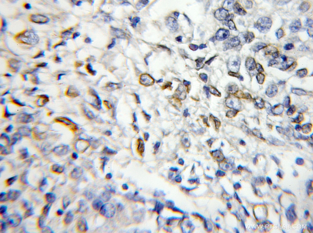 Immunohistochemistry (IHC) staining of human lung cancer tissue using RABL2B Polyclonal antibody (11588-1-AP)