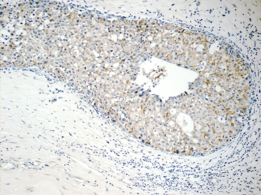Immunohistochemistry (IHC) staining of human breast cancer tissue using RABL3 Polyclonal antibody (11916-1-AP)