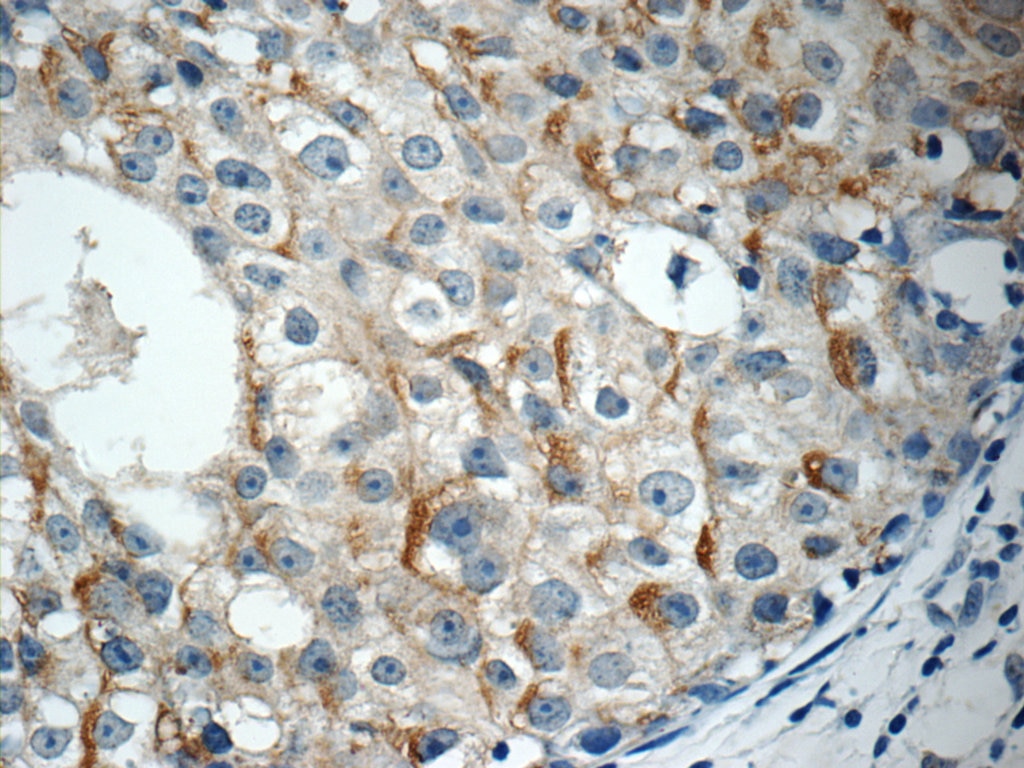 Immunohistochemistry (IHC) staining of human breast cancer tissue using RABL3 Polyclonal antibody (11916-1-AP)