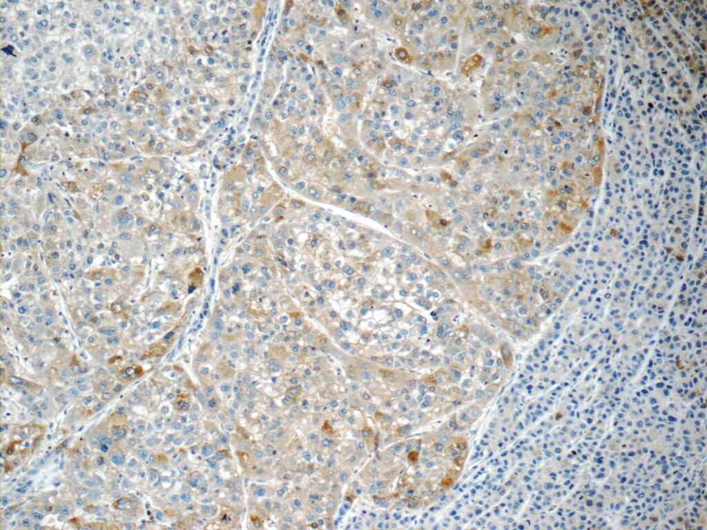 Immunohistochemistry (IHC) staining of human liver cancer tissue using RABL3 Polyclonal antibody (11916-1-AP)