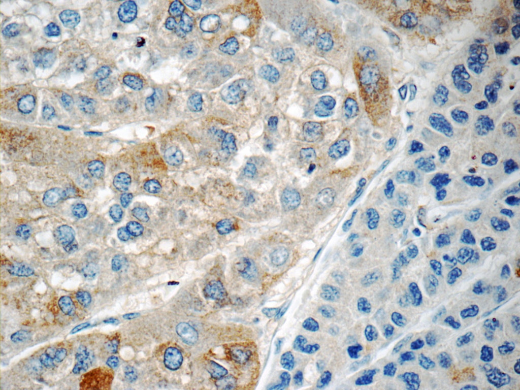 Immunohistochemistry (IHC) staining of human liver cancer tissue using RABL3 Polyclonal antibody (11916-1-AP)