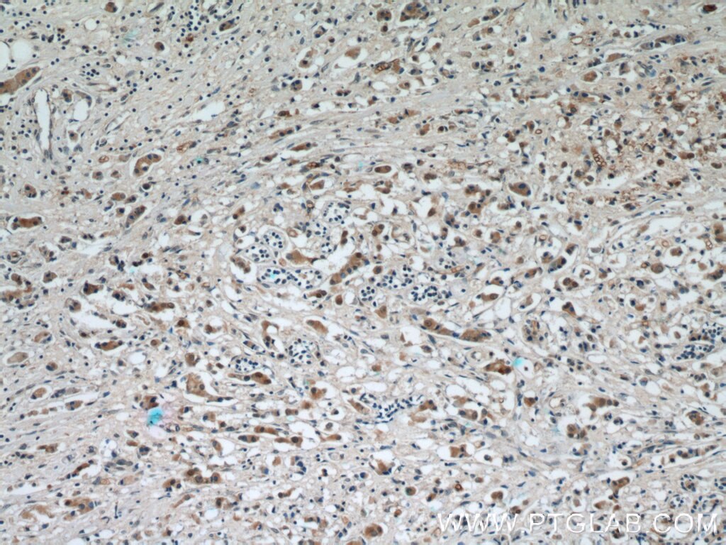 Immunohistochemistry (IHC) staining of human breast cancer tissue using RABL3 Polyclonal antibody (11916-1-AP)