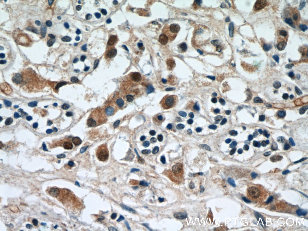 Immunohistochemistry (IHC) staining of human breast cancer tissue using RABL3 Polyclonal antibody (11916-1-AP)