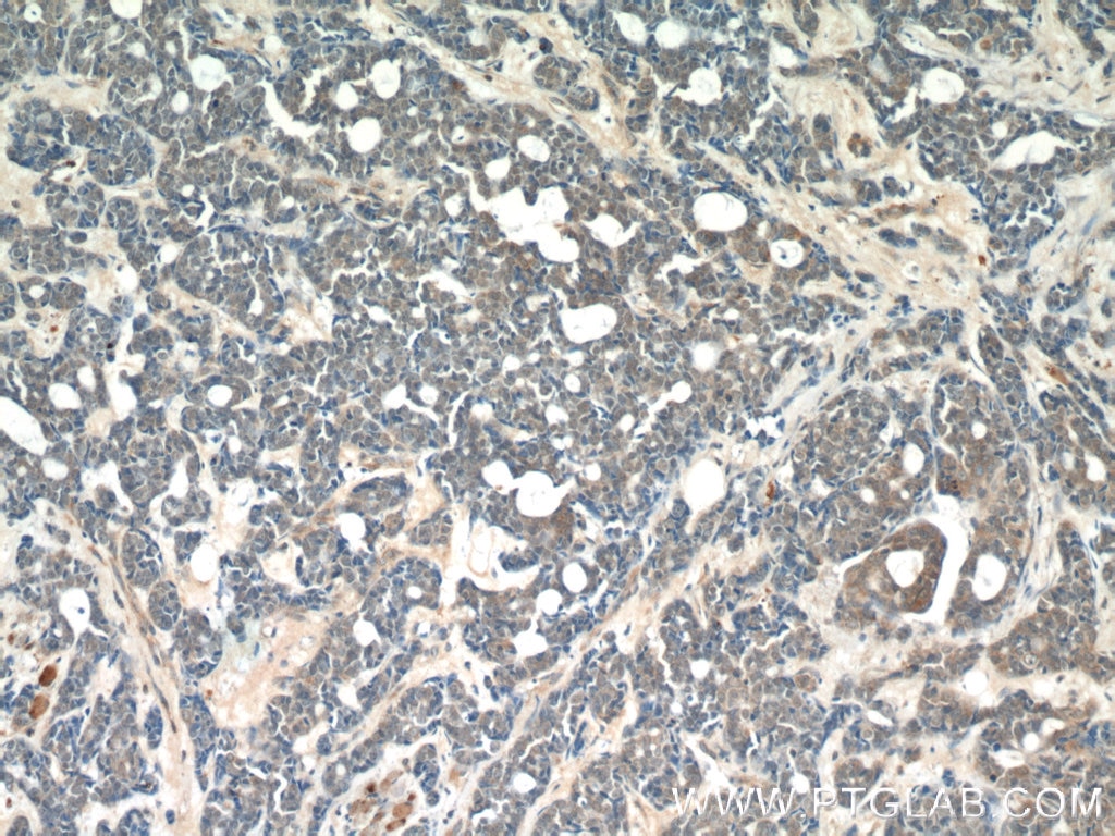 Immunohistochemistry (IHC) staining of human cervical cancer tissue using RABL3 Polyclonal antibody (11916-1-AP)