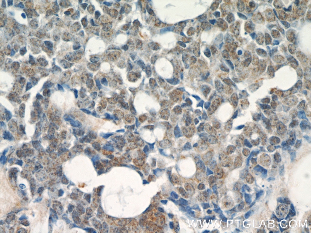IHC staining of human cervical cancer using 11916-1-AP