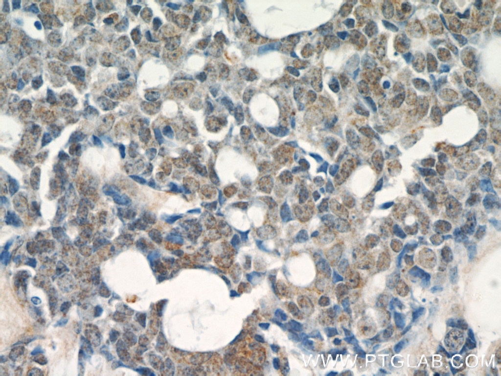 Immunohistochemistry (IHC) staining of human cervical cancer tissue using RABL3 Polyclonal antibody (11916-1-AP)