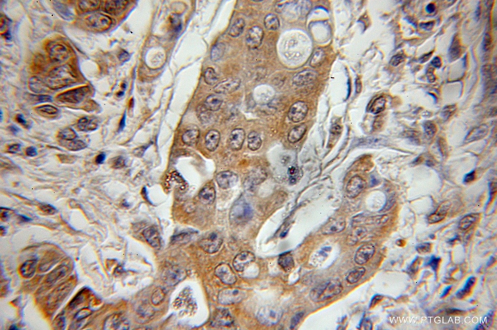 Immunohistochemistry (IHC) staining of human colon cancer tissue using Rac1 Polyclonal antibody (10485-2-AP)