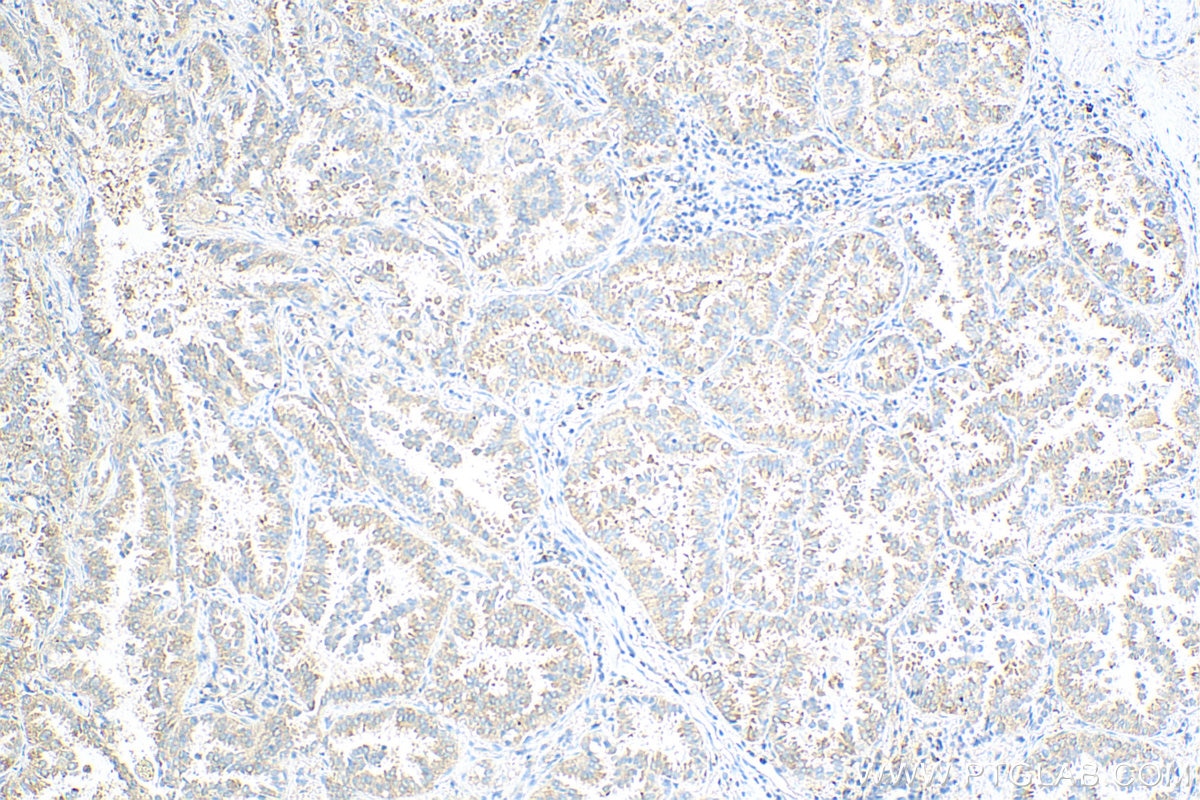 Immunohistochemistry (IHC) staining of human lung cancer tissue using Rac1 Polyclonal antibody (24072-1-AP)