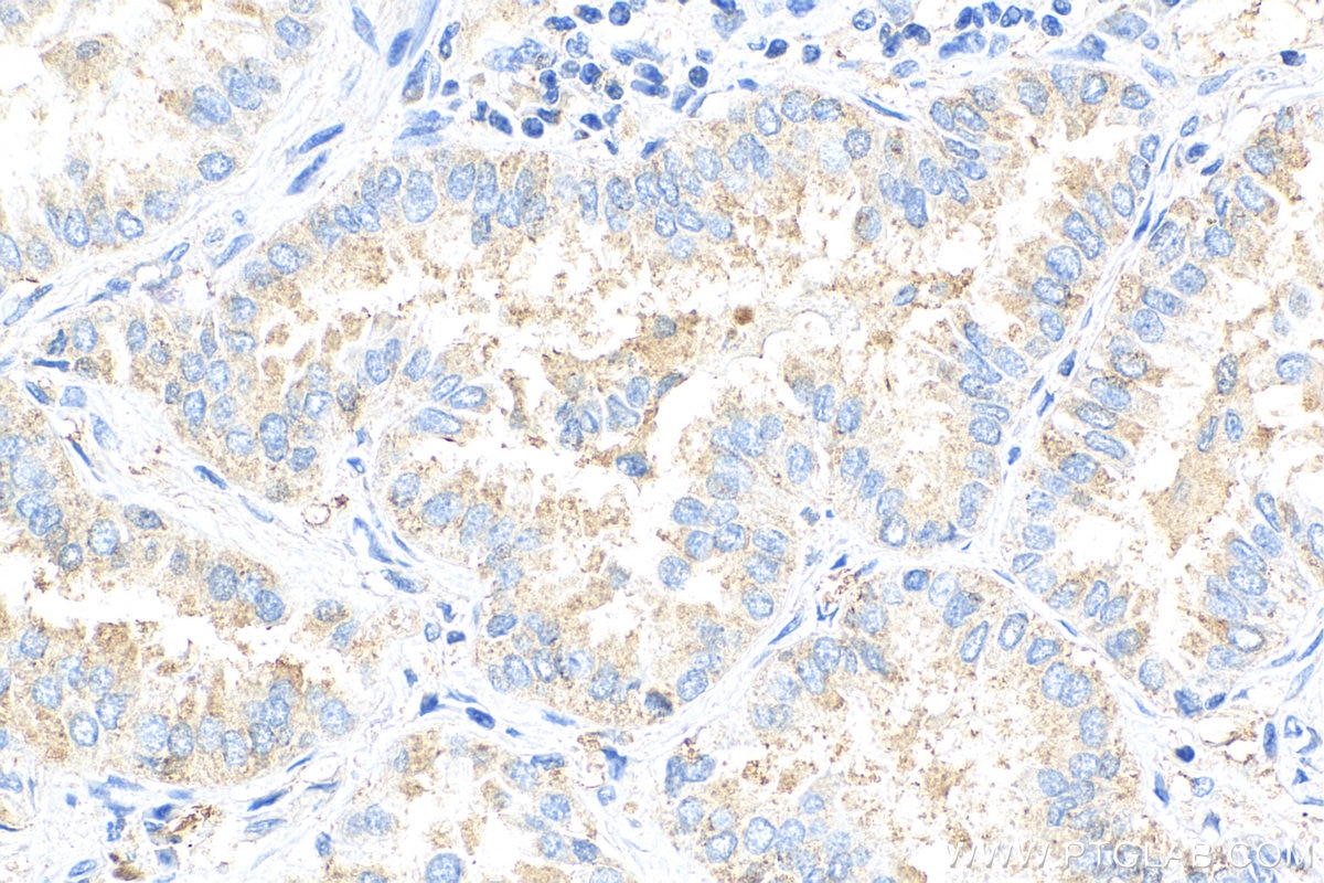 Immunohistochemistry (IHC) staining of human lung cancer tissue using Rac1 Polyclonal antibody (24072-1-AP)