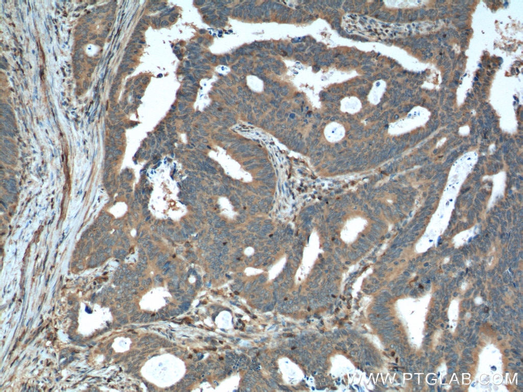 Immunohistochemistry (IHC) staining of human colon cancer tissue using RAC1 Monoclonal antibody (66122-1-Ig)