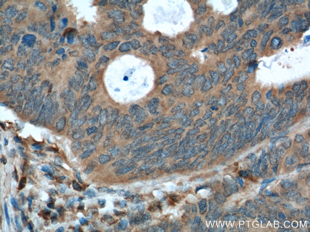 Immunohistochemistry (IHC) staining of human colon cancer tissue using RAC1 Monoclonal antibody (66122-1-Ig)