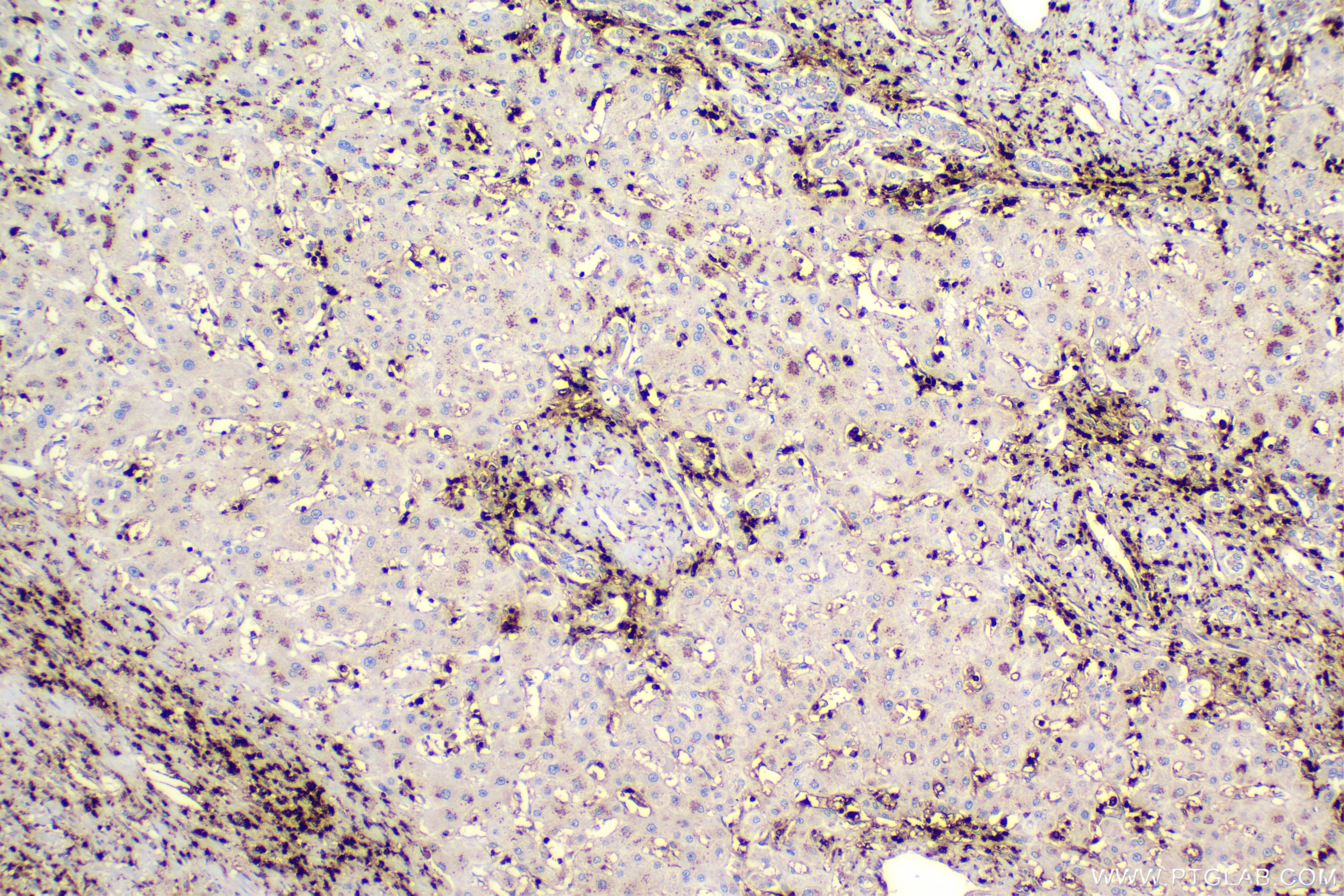 IHC staining of human liver cancer using 88471-1-RR Immunohistochemistry (IHC) staining of human liver cancer tissue using RAC1 Recombinant monoclonal antibody (88471-1-RR)