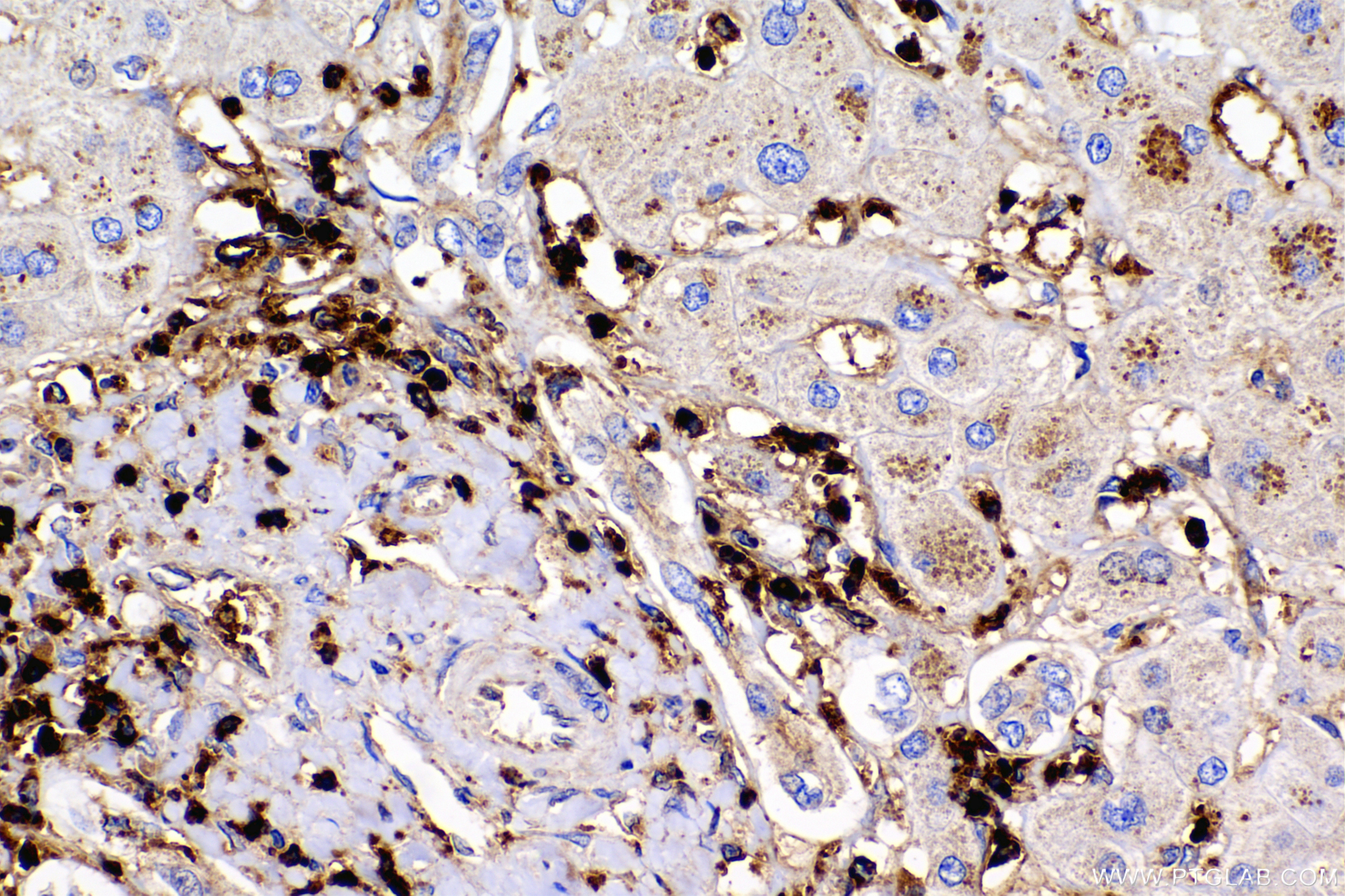 IHC staining of human liver cancer using 88471-1-RR Immunohistochemistry (IHC) staining of human liver cancer tissue using RAC1 Recombinant monoclonal antibody (88471-1-RR)