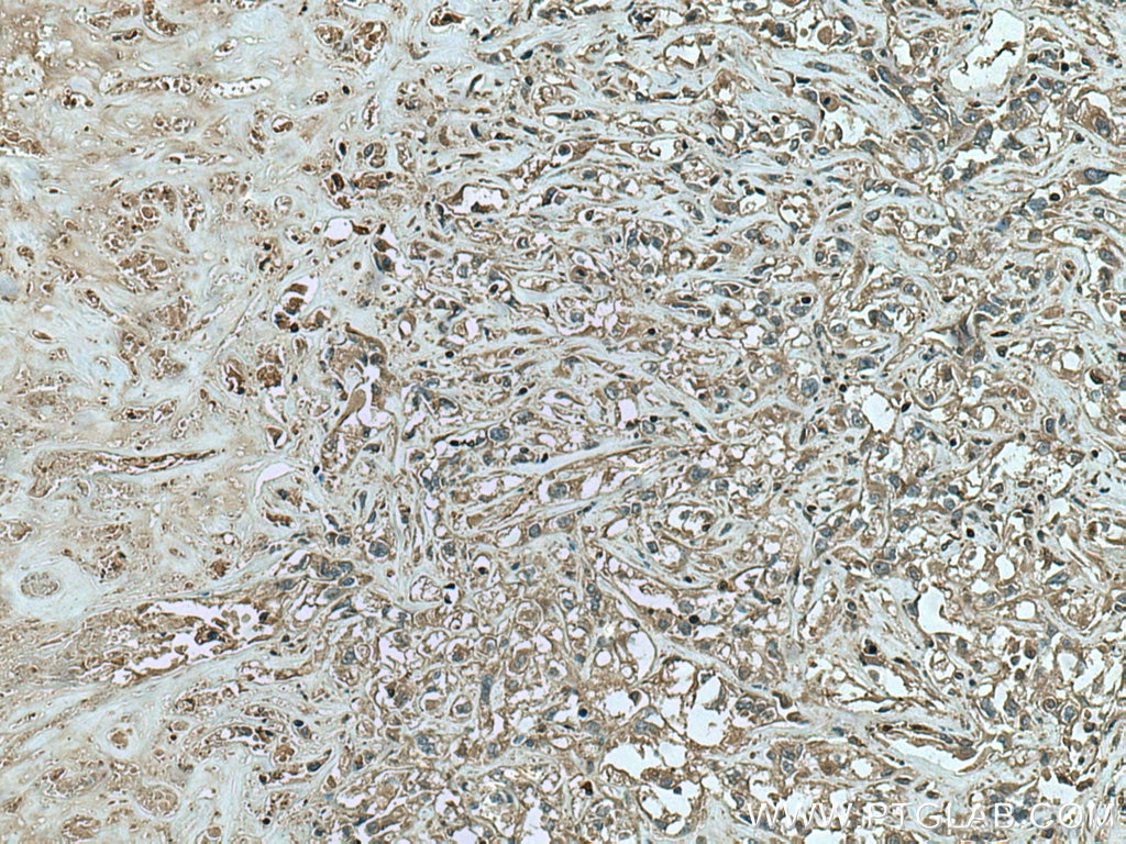 Immunohistochemistry (IHC) staining of human renal cell carcinoma tissue using RAC2 Polyclonal antibody (10735-1-AP)