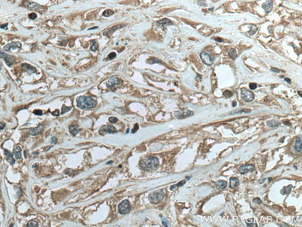 Immunohistochemistry (IHC) staining of human renal cell carcinoma tissue using RAC2 Polyclonal antibody (10735-1-AP)