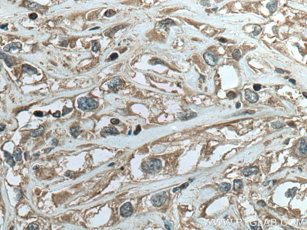 IHC staining of human renal cell carcinoma using 10735-1-AP