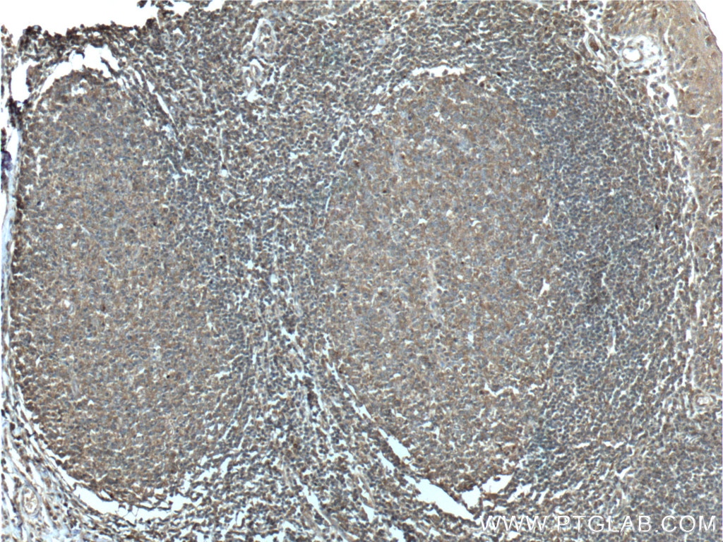 Immunohistochemistry (IHC) staining of human tonsillitis tissue using RAC2 Polyclonal antibody (10735-1-AP)