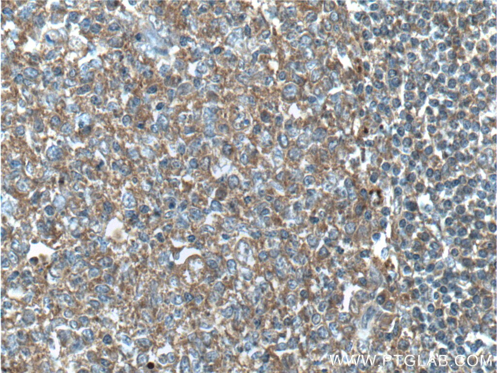 IHC staining of human tonsillitis using 10735-1-AP