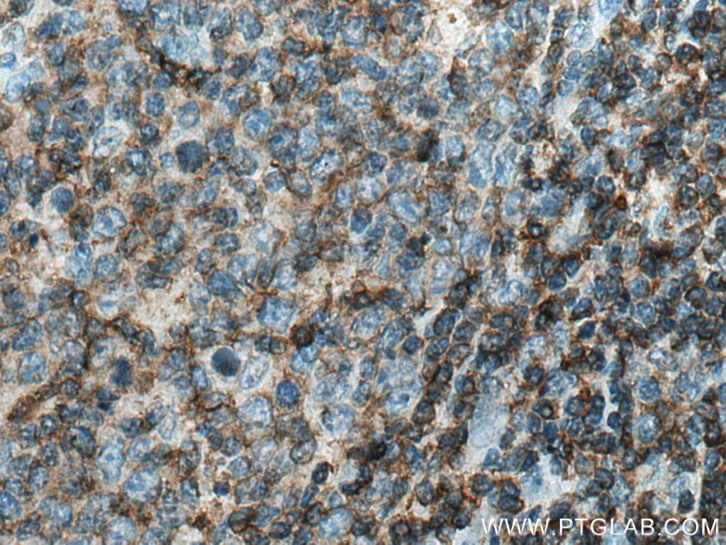 IHC staining of human tonsillitis using 60077-1-Ig