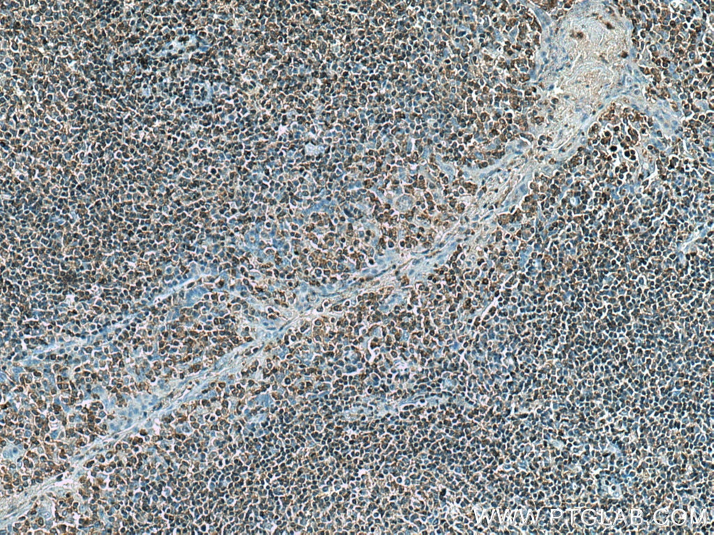 Immunohistochemistry (IHC) staining of human tonsillitis tissue using RAC2 Monoclonal antibody (60077-1-Ig)