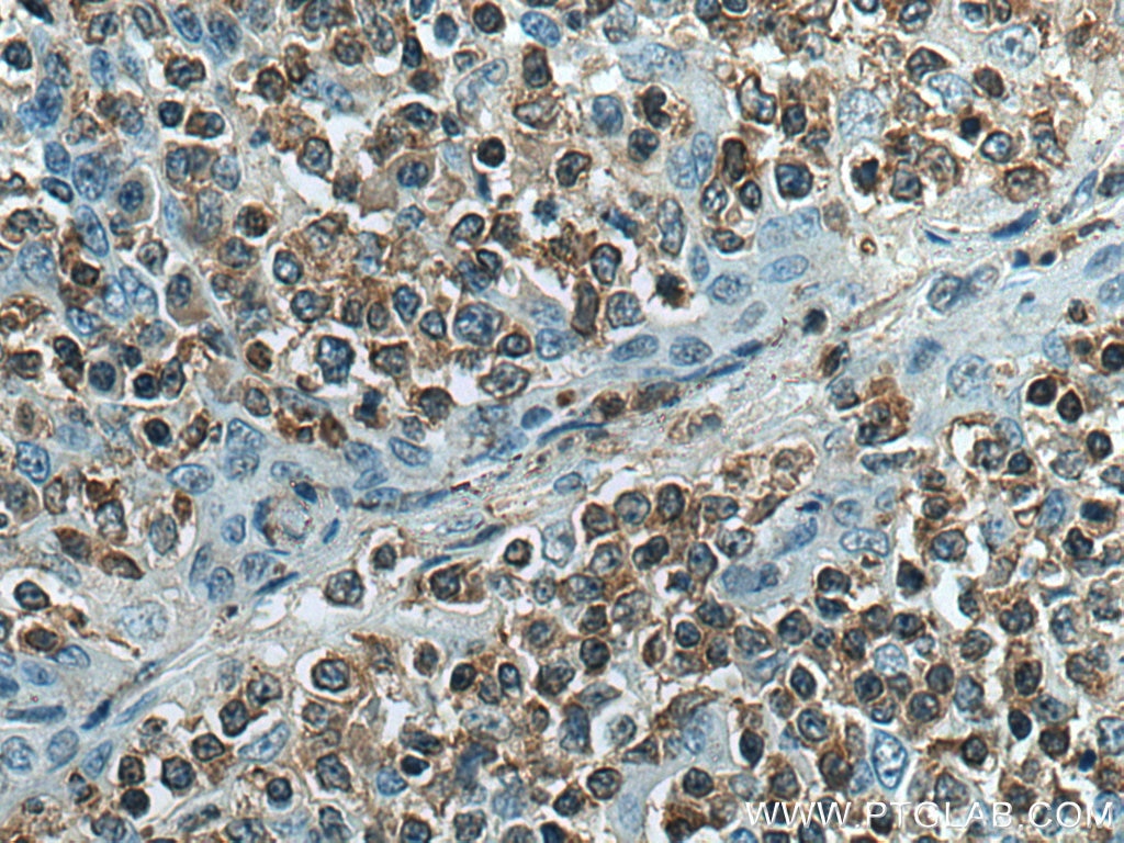 Immunohistochemistry (IHC) staining of human tonsillitis tissue using RAC2 Monoclonal antibody (60077-1-Ig)