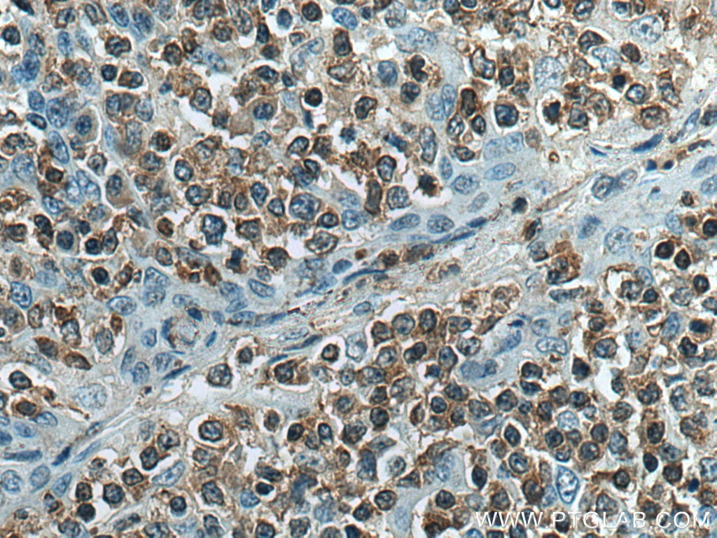 IHC staining of human tonsillitis using 60077-1-Ig