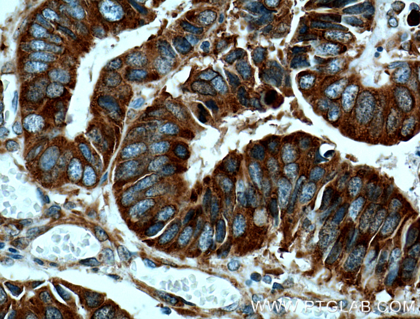 Immunohistochemistry (IHC) staining of human colon cancer tissue using RACGAP1 Monoclonal antibody (66056-1-Ig)