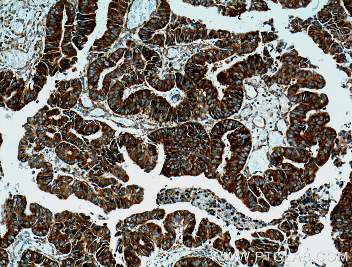 Immunohistochemistry (IHC) staining of human colon cancer tissue using RACGAP1 Monoclonal antibody (66056-1-Ig)