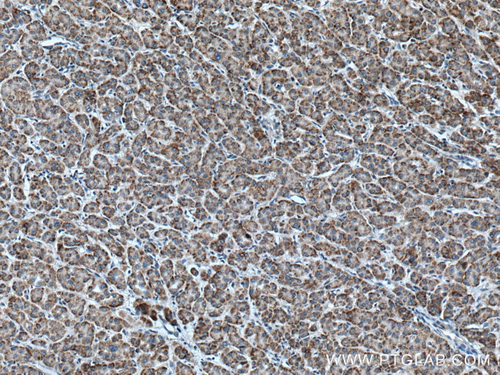 Immunohistochemistry (IHC) staining of human liver cancer tissue using RACK1; GNB2L1 Polyclonal antibody (27592-1-AP)
