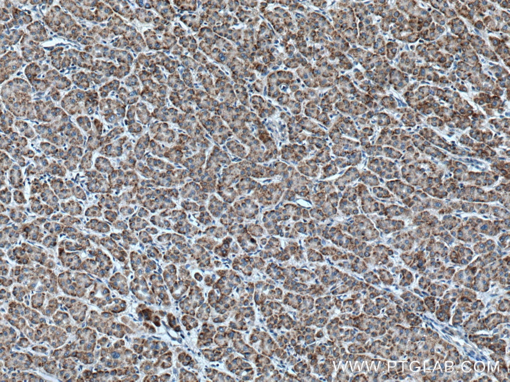 IHC staining of human liver cancer using 27592-1-AP