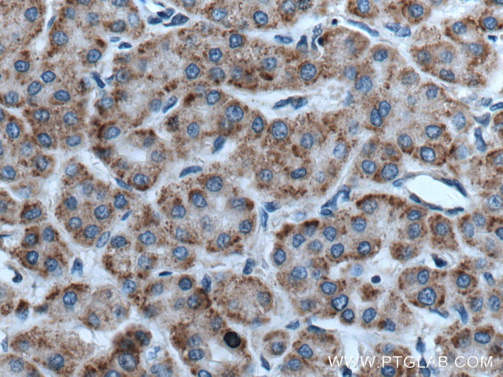 IHC staining of human liver cancer using 27592-1-AP