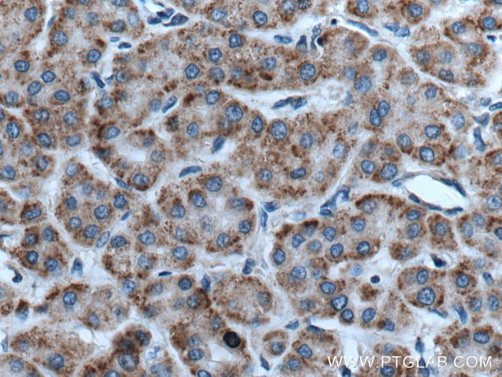 Immunohistochemistry (IHC) staining of human liver cancer tissue using RACK1; GNB2L1 Polyclonal antibody (27592-1-AP)