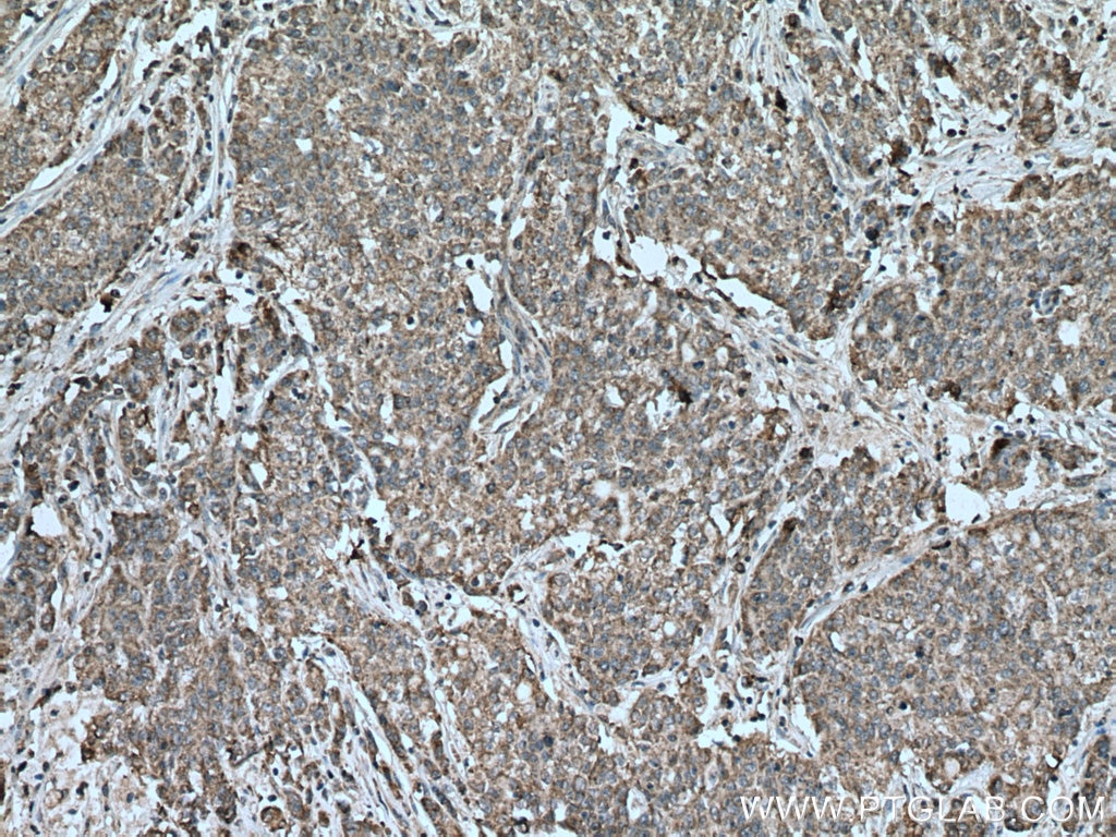 Immunohistochemistry (IHC) staining of human stomach cancer tissue using RACK1; GNB2L1 Polyclonal antibody (27592-1-AP)