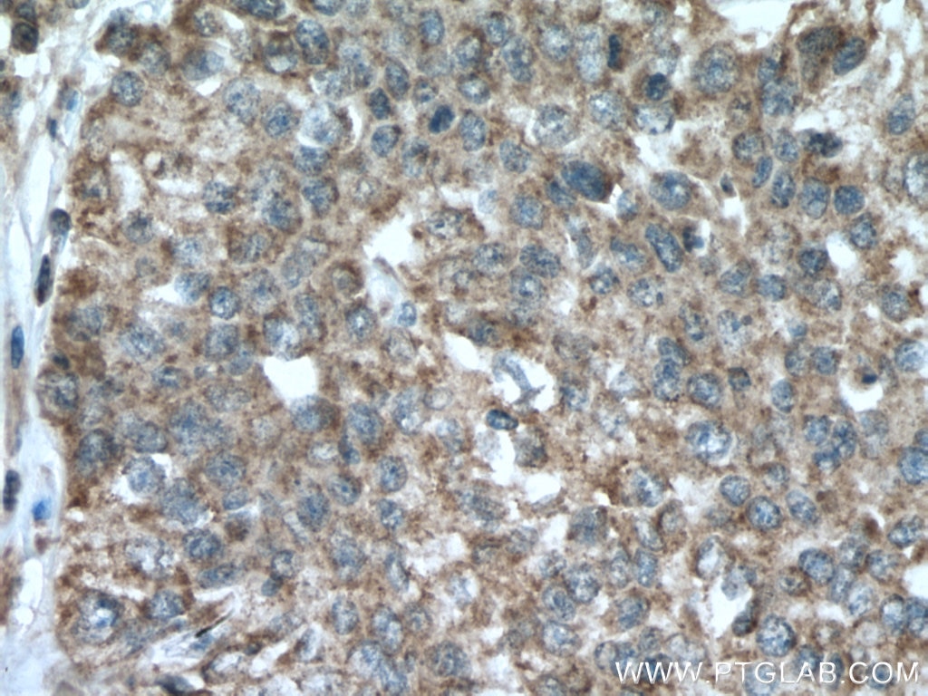 Immunohistochemistry (IHC) staining of human stomach cancer tissue using RACK1; GNB2L1 Polyclonal antibody (27592-1-AP)