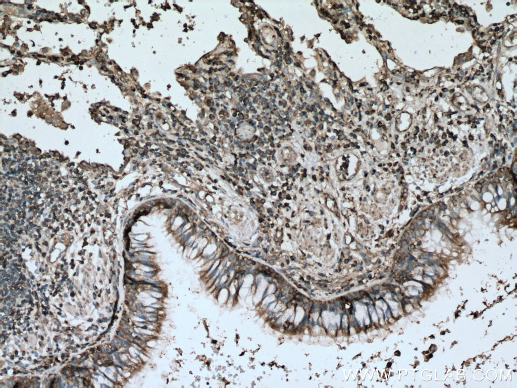 IHC staining of human lung cancer using 66940-1-Ig