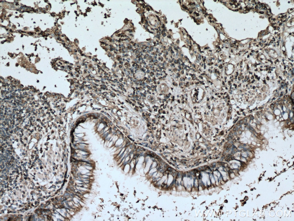 Immunohistochemistry (IHC) staining of human lung cancer tissue using RACK1; GNB2L1 Monoclonal antibody (66940-1-Ig)