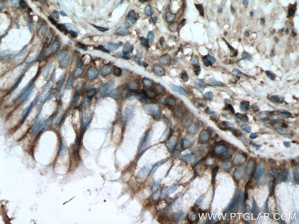 Immunohistochemistry (IHC) staining of human lung cancer tissue using RACK1; GNB2L1 Monoclonal antibody (66940-1-Ig)