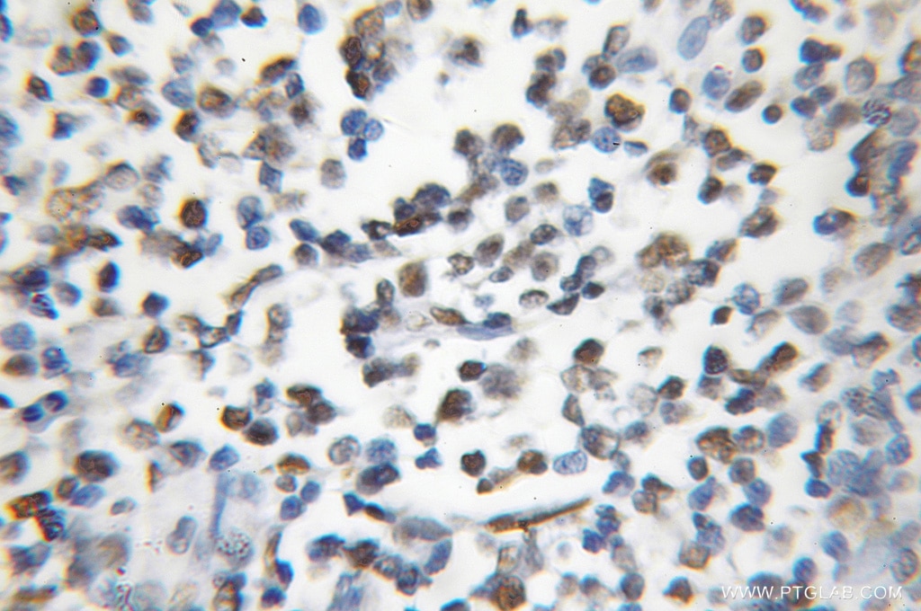 IHC staining of human lymphoma using 11726-2-AP