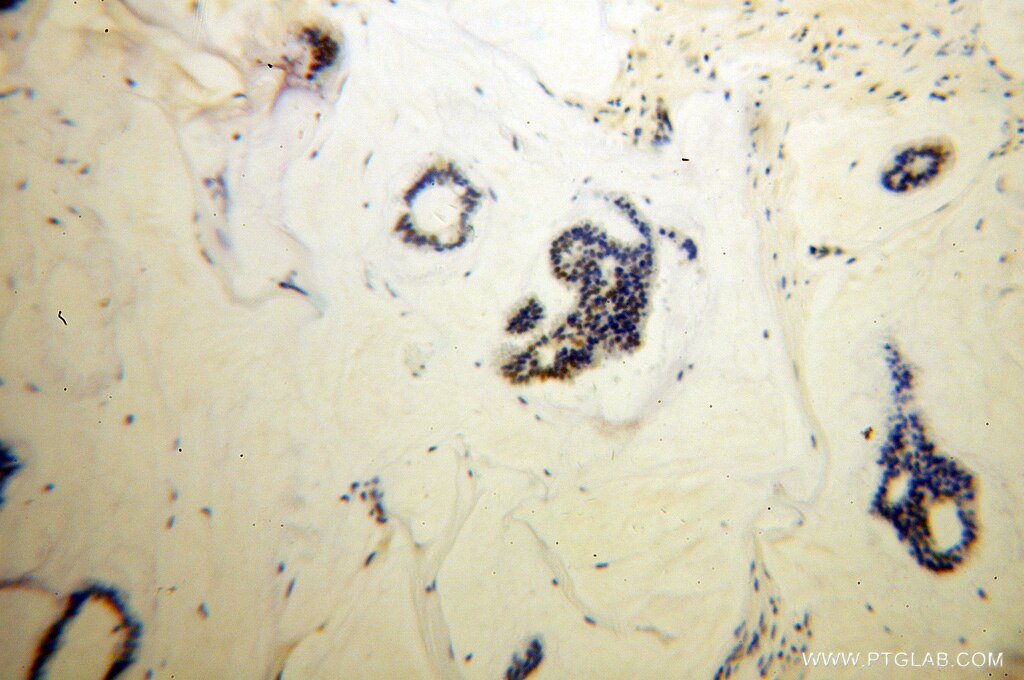 Immunohistochemistry (IHC) staining of human breast cancer tissue using RAD17 Polyclonal antibody (13358-1-AP)