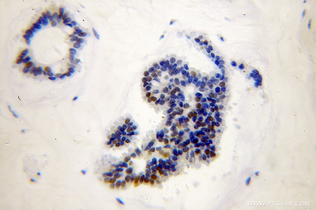 Immunohistochemistry (IHC) staining of human breast cancer tissue using RAD17 Polyclonal antibody (13358-1-AP)