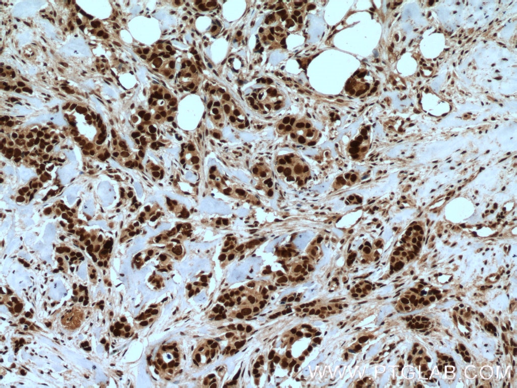Immunohistochemistry (IHC) staining of human breast cancer tissue using RAD21 Polyclonal antibody (27071-1-AP)